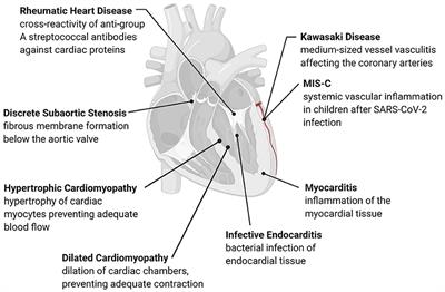 The Immune and Inflammatory Basis of Acquired Pediatric Cardiac Disease